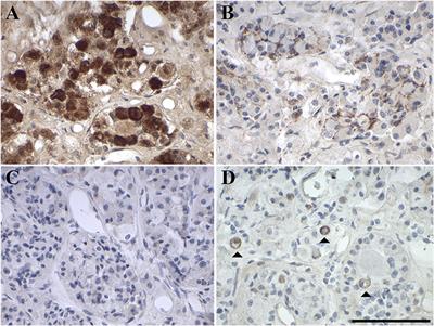 Galanin System in Human Glioma and Pituitary Adenoma